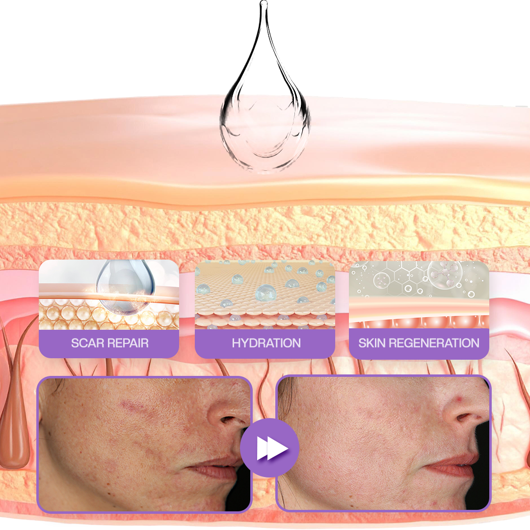 🔥LOVILDS® RevivaDerma Face & Body Scar Gel - Clinically proven to soften, flatten and fade surgical scars, acne marks, burns, keloids and trauma-related scars